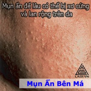 Mụn Ẩn Bên Má - Nguyên Nhân Nổi Mụn Ẩn