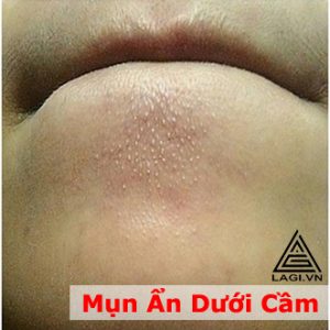 Mụn Ẩn Dưới Cầm