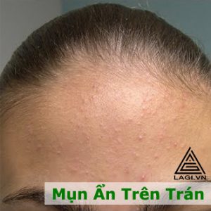 Mụn Ẩn Trên Trán