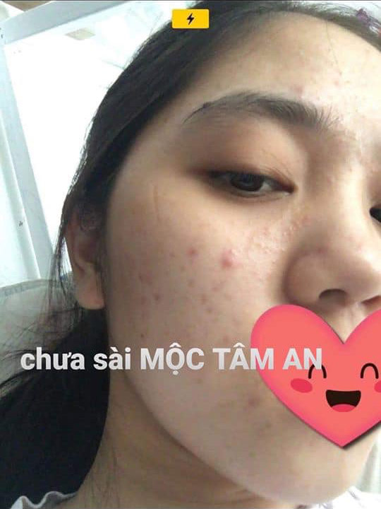 Kết Quả Trị Mụn Với Mộc Tâm An