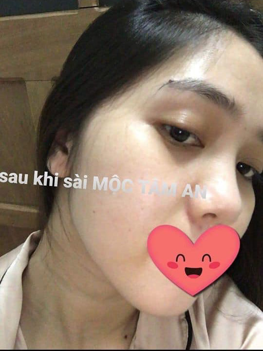 Kết Quả Trị Mụn Với Mộc Tâm An