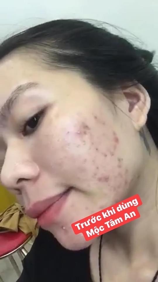 Mộc Tâm An Trị Mụn Có HẾT không