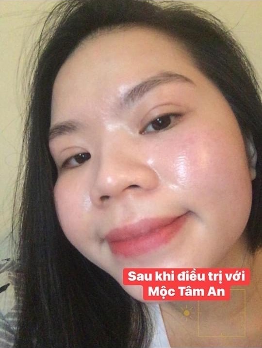 Mộc Tâm An Trị Mụn Có HẾT không