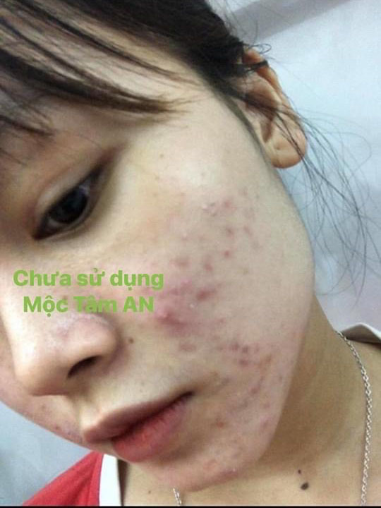 Stress Vì Mụn Kéo Dài Đăng Đẳng Không Hết